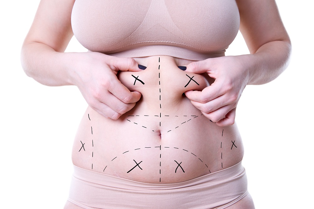 LIPOSUCTION